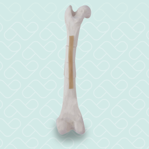 FEMUR ESPONJOSO COM FRATURAS MULTIPLAS 2  - ESQUERDO - CÃO GRANDE - cód. AV250ESPF3